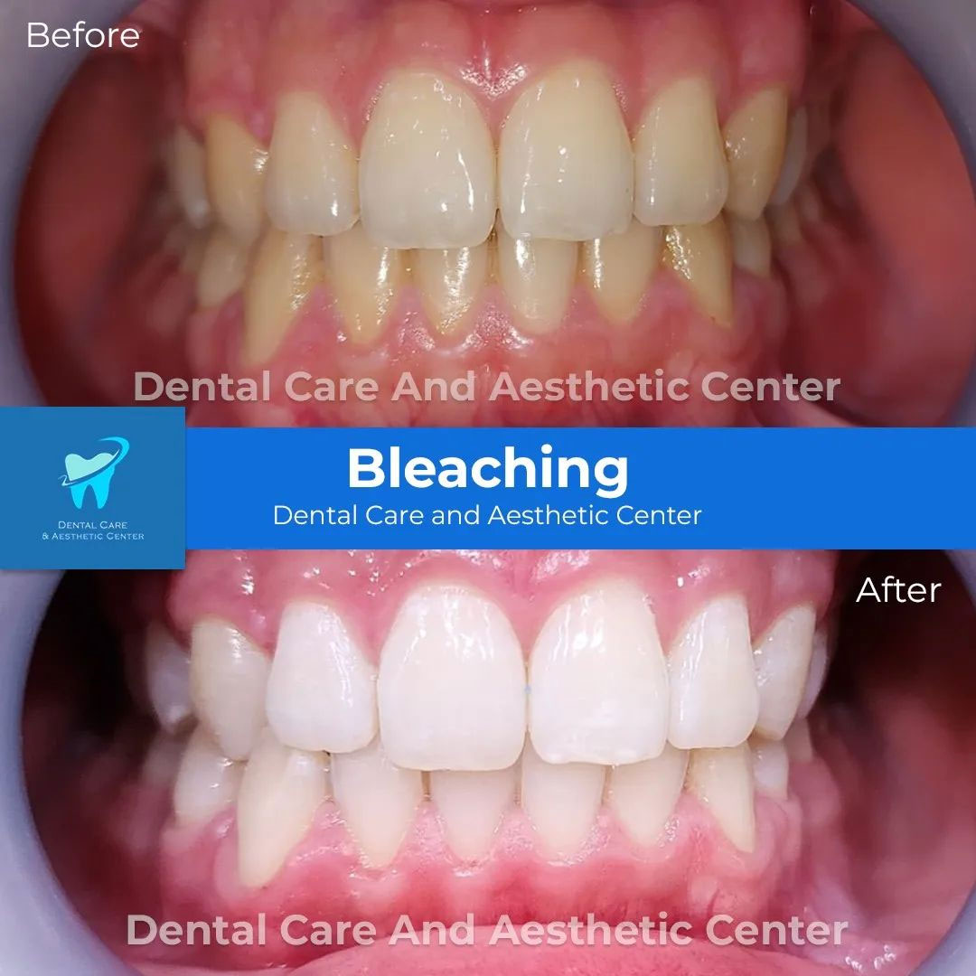 Bleaching
